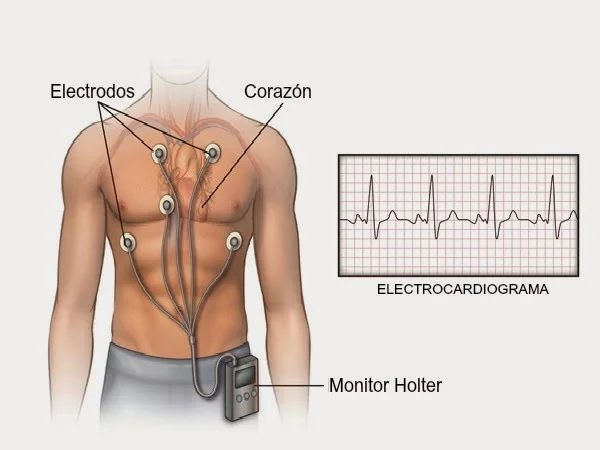 Monitoreo Holter (estudio de arritmias)