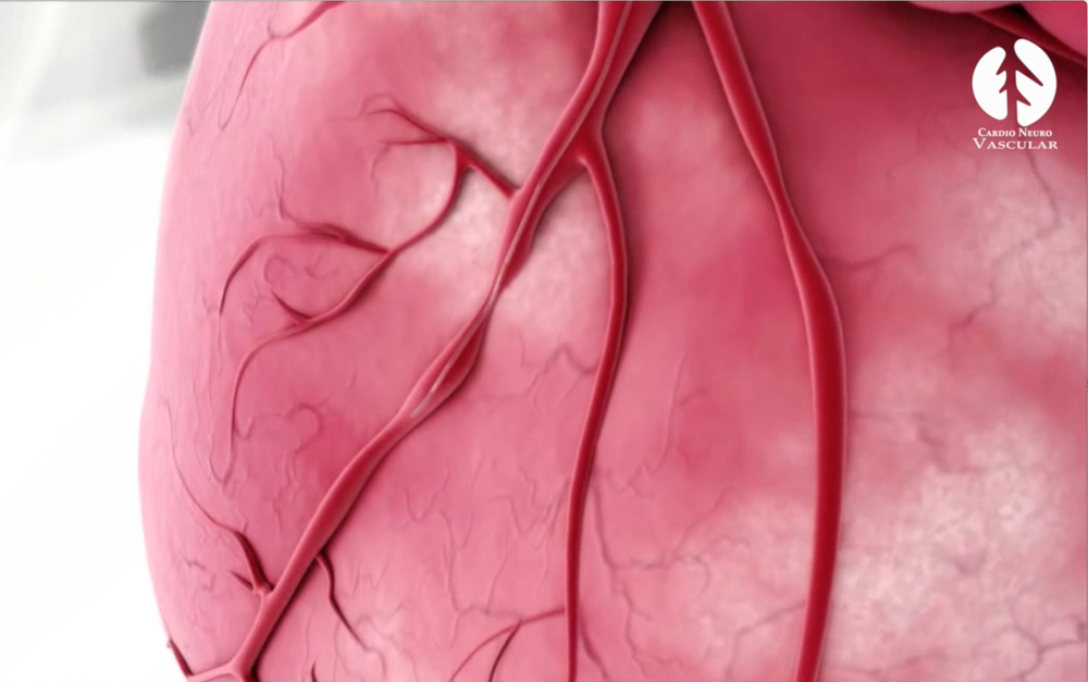 Cateterismo Cardiaco Arteriografia Y Angioplastia Coronarias Clinica Cardioneurovascular