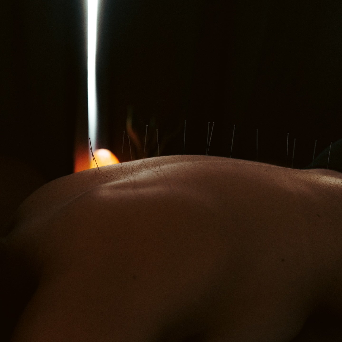 ☀️ Summer is here&mdash;and so is the season of doing the most. Vacations, late nights, sun-soaked days&hellip; it&rsquo;s easy to forget about your own energy in the middle of it all.

Acupuncture is the perfect reset for summer burnout&mdash;boosti