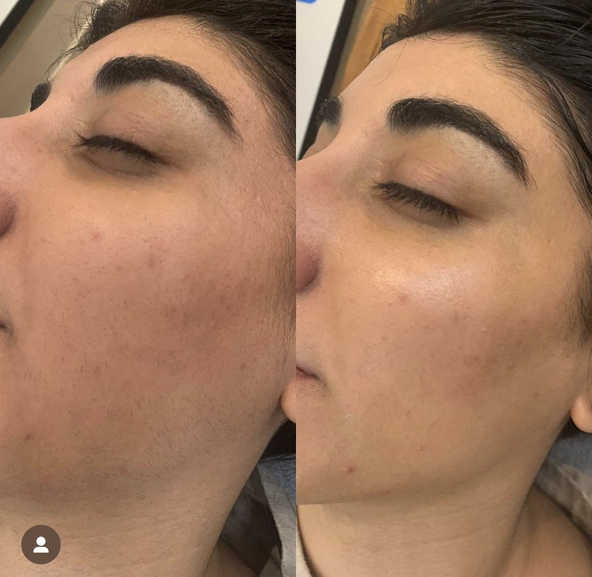 Dermaplaning by Alexis