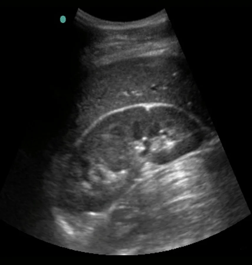 Normal Kidney Ultrasound Normal Kidney Ultrasound