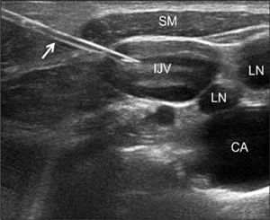 Ultrasound Guided Vascular Access