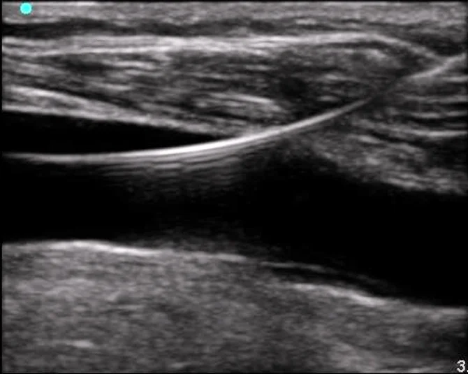 Ultrasound Guided Vascular Access — MMHEME