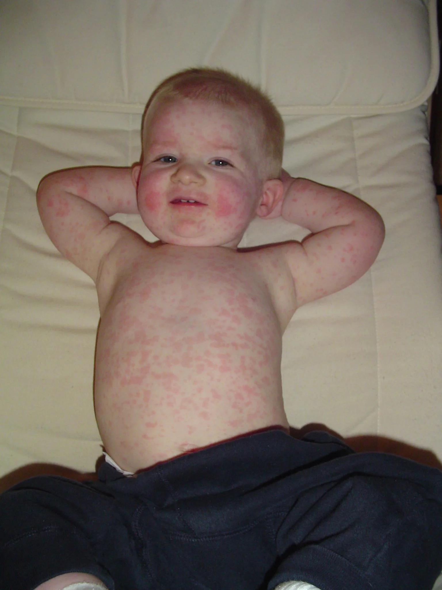 Rash.jpg