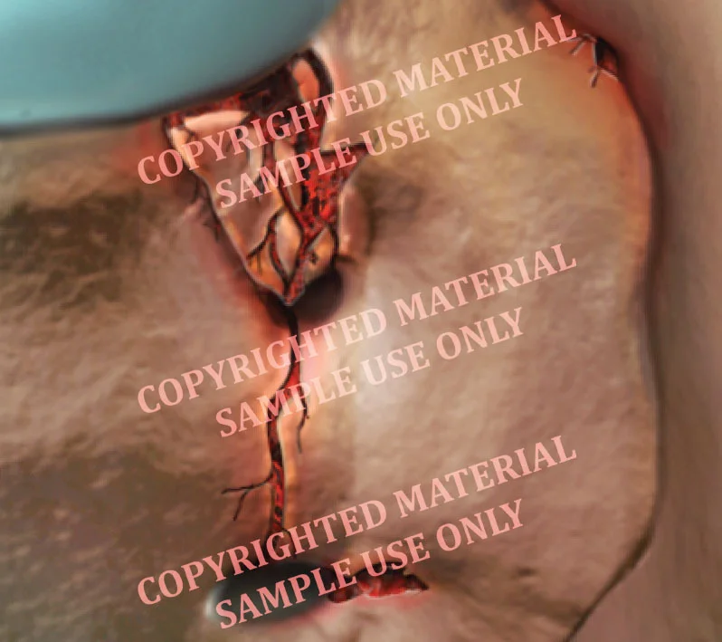 Medical-legal exhibit - Sacral fracture inset