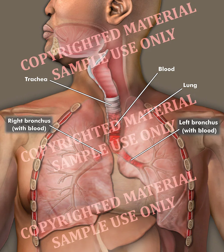 Medical-legal exhibit - Blood in bronchus