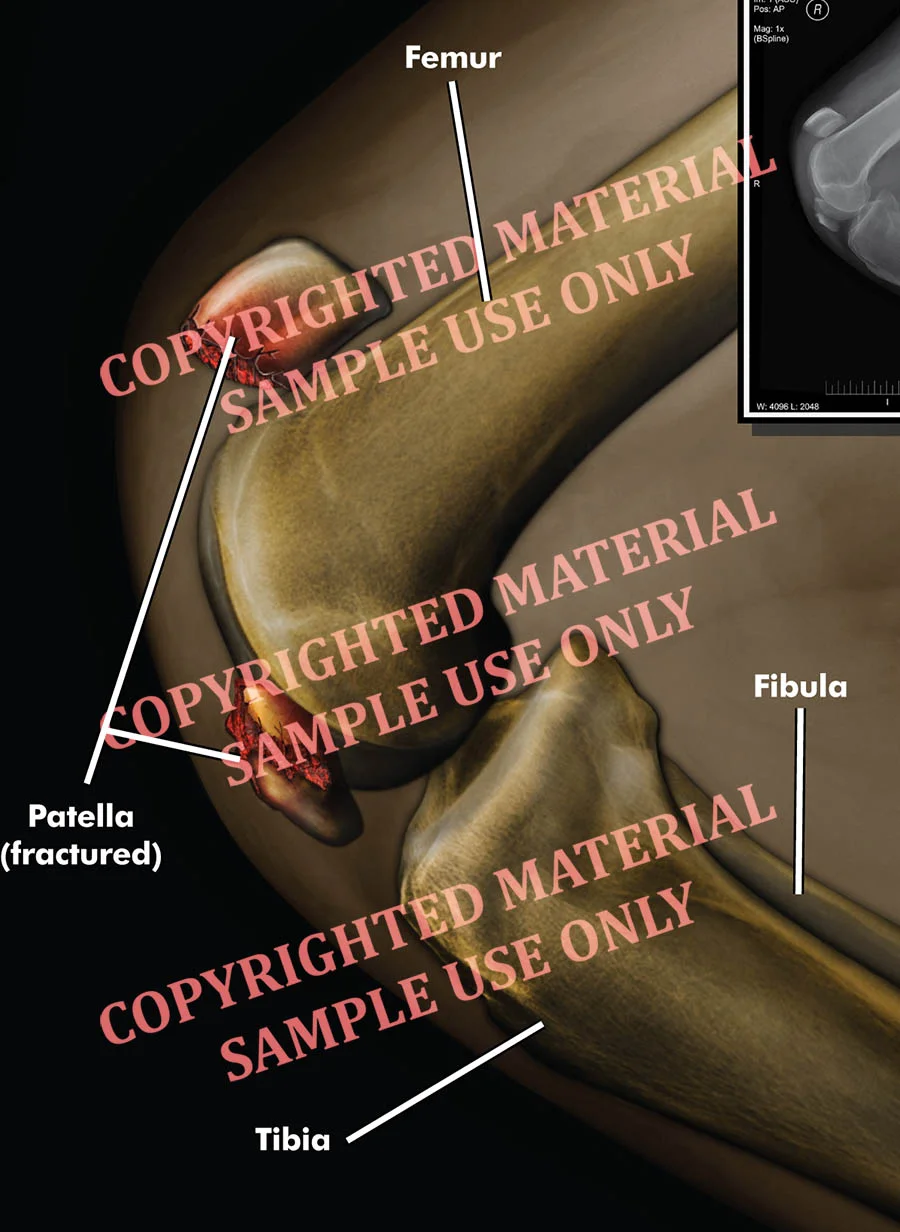 Medical-legal exhibit - Colorized film showing patella fracture
