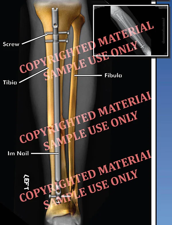 Medical-legal exhibit - Colorized film showing post-op hardware in femur