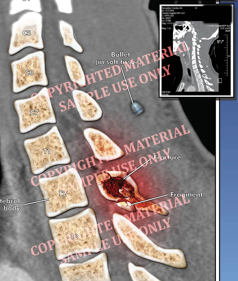 Medical-legal exhibit - Colorized film showing location of fractured cervical vertebrae and resting place of bullet in neck