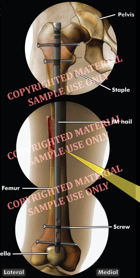 Medical-legal exhibit - Colorized films combined to show IM nail in femur