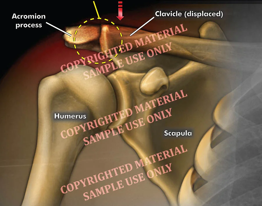 Medical-legal exhibit - Colorized film showing displaced clavicle