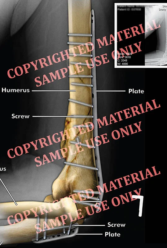 Medical-legal exhibit - Colorized film showing hardware in place at humerus and ulna