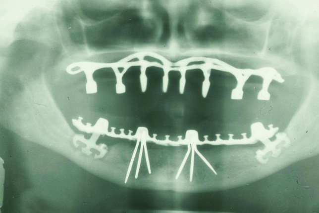  Panoramic radiograph of historic dental implants (1978) 
