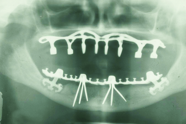 Panoramic radiograph of historic dental implants (1978)