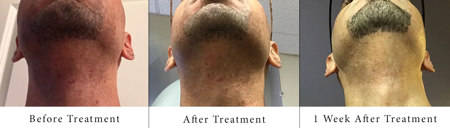 sam-c-perry-the-truth-about-laser-hair-removal-treatment-results-2.jpg.jpg