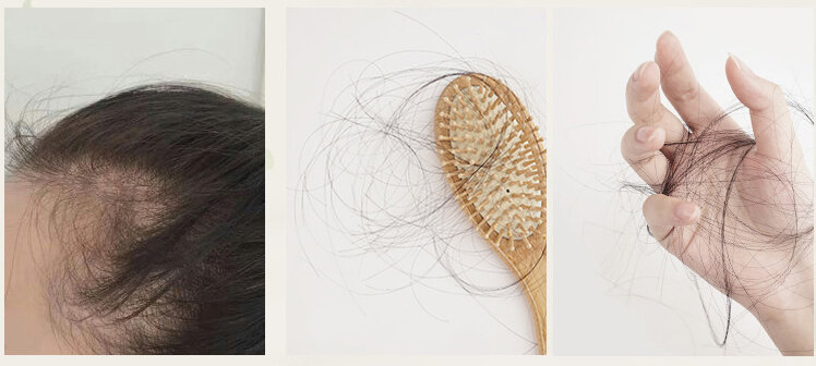 Hair Shedding – What You Should Know — PCOS Awareness Association