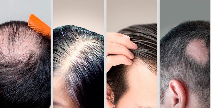 RU58841 5% + KETO for Men Hair Loss & Regrowth DHT inhibitor. | eBay