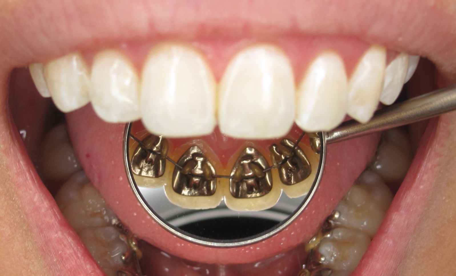 Lingual Braces Look.jpg