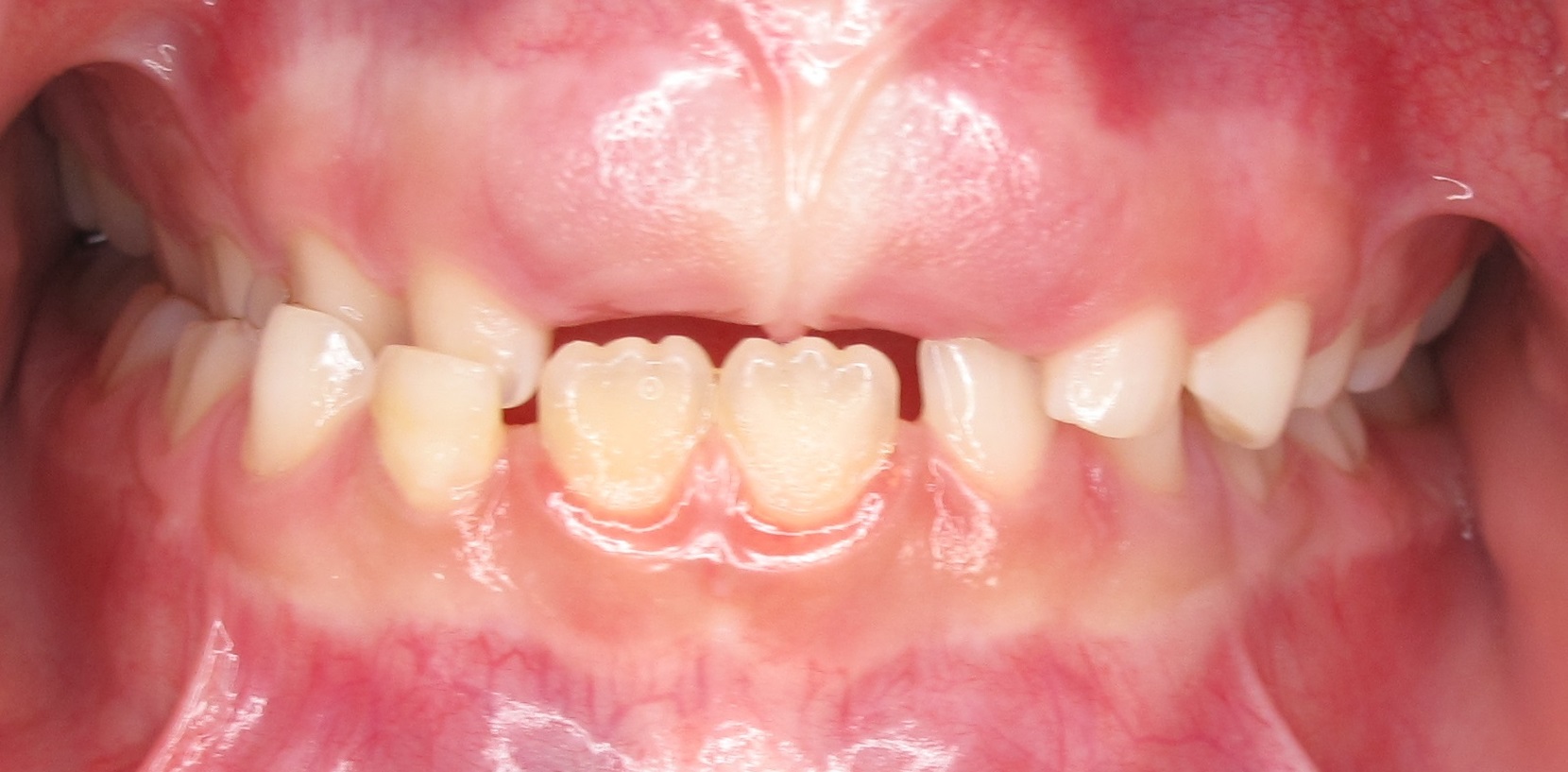 Case #3- Severe Crossbite and Delayed Eruption of Adult Teeth