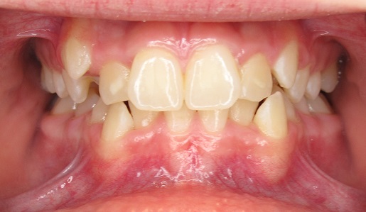 Case #4- Crowding in Both Arches