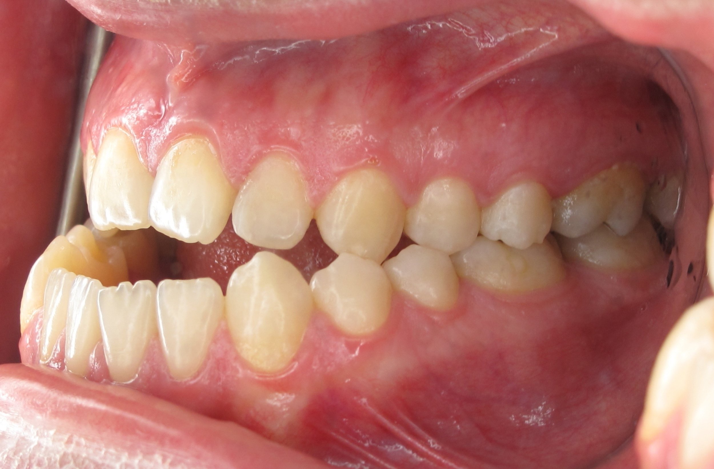 Case #5- Under bite Correction with Jaw Surgery