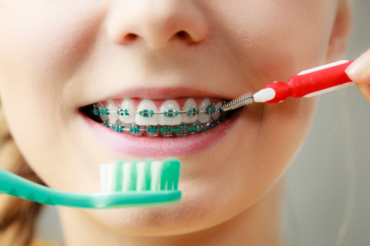 How to Take Care of Braces for Kids: A Guide to Cleaning & Caring for Braces