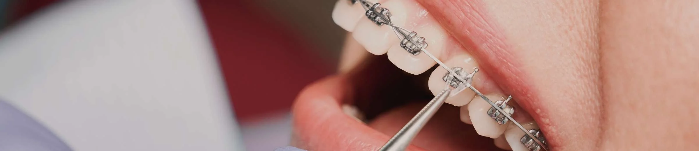 Do Braces Hurt? What To Expect When Getting Braces