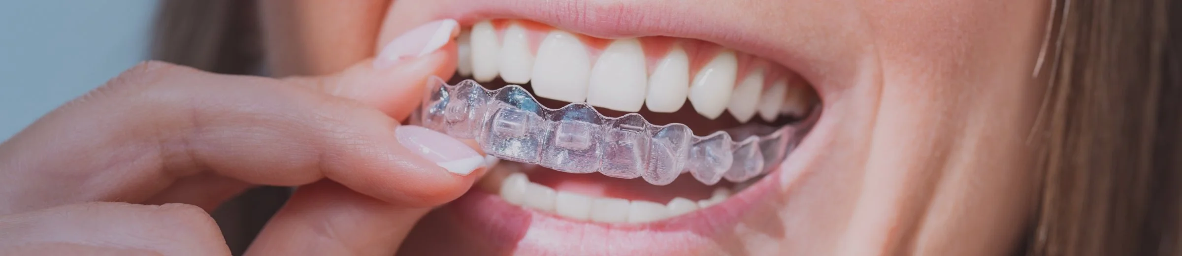 Why Do You Need a Retainer After Braces? The Importance of Guarding Your Orthodontic Investment