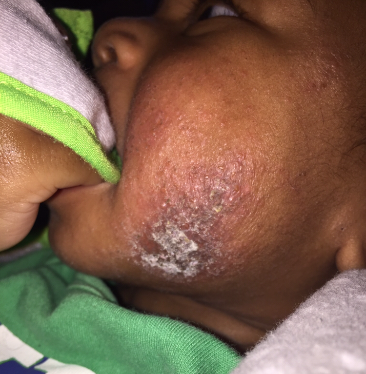 Right After The Antibiotic
