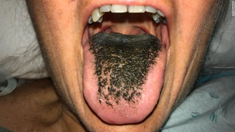 Home Care for Your Tongue and Soft Tissue