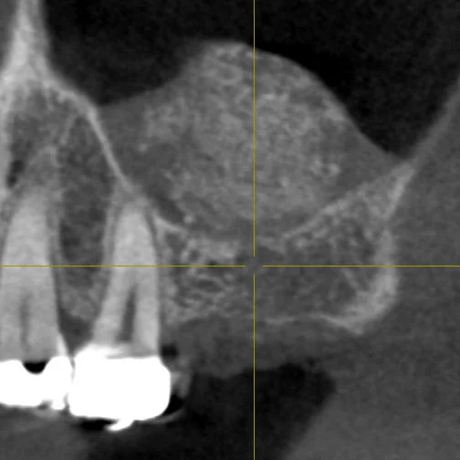 This image was taken immediately after the lateral window sinus lift in October of 2014. The volume and height of bone has been increased. This image is a cross section of a 3D image.