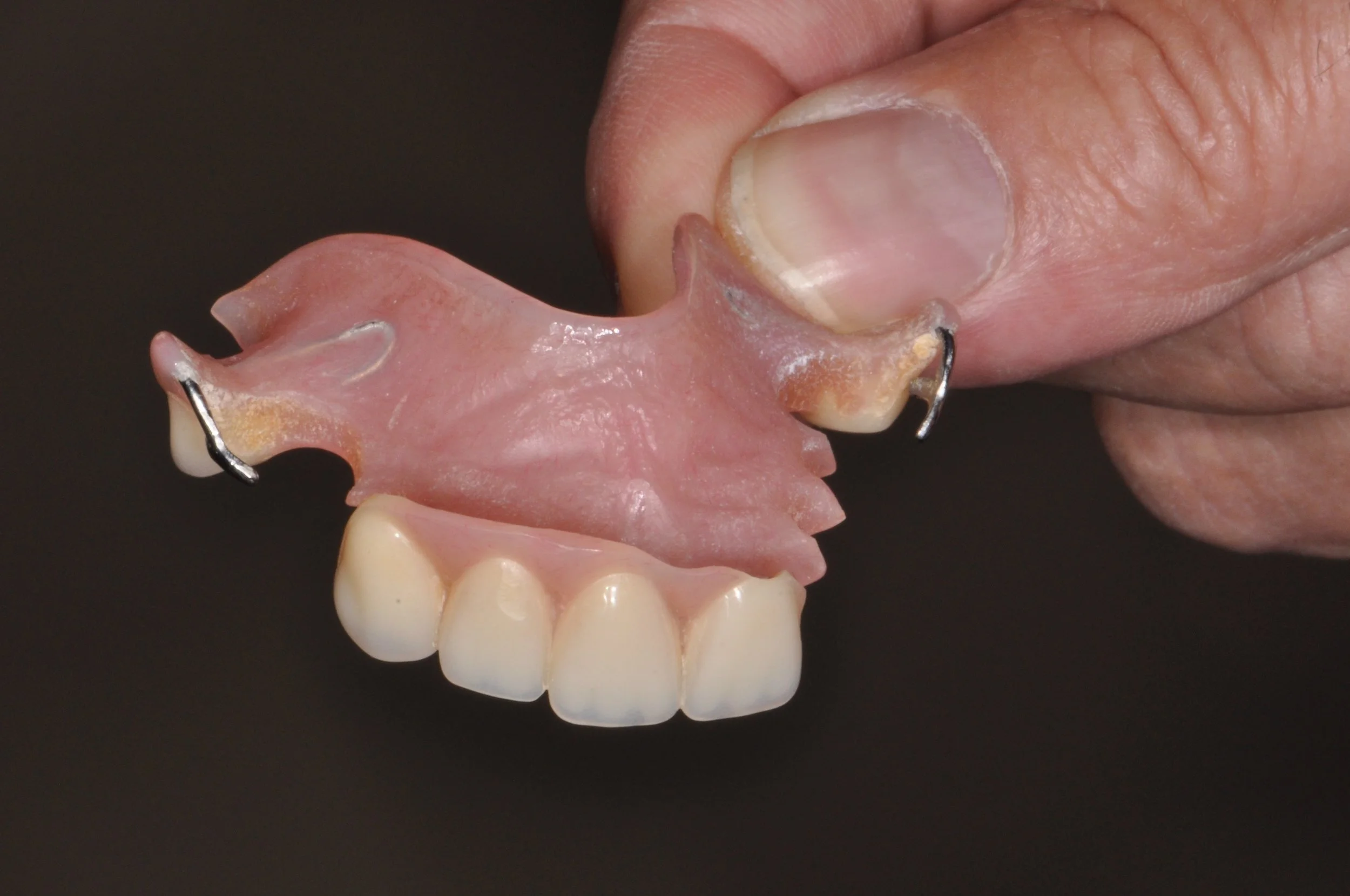 Patient presented with a removable partial denture. This was used during treatment to maintain teeth in the anterior region. Patient elected to have dental implants and a fixed bridge placed.