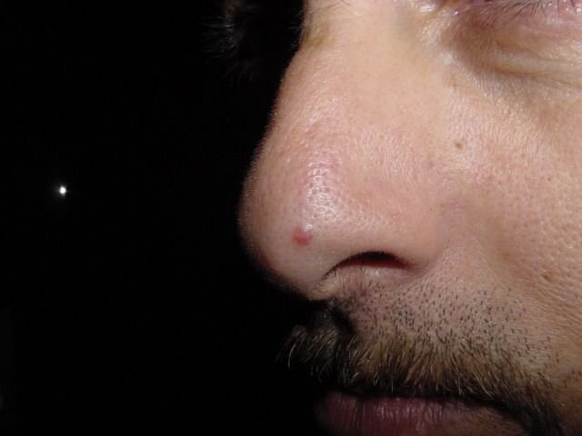 PICS_Lesions-Human_Nose-03.jpg