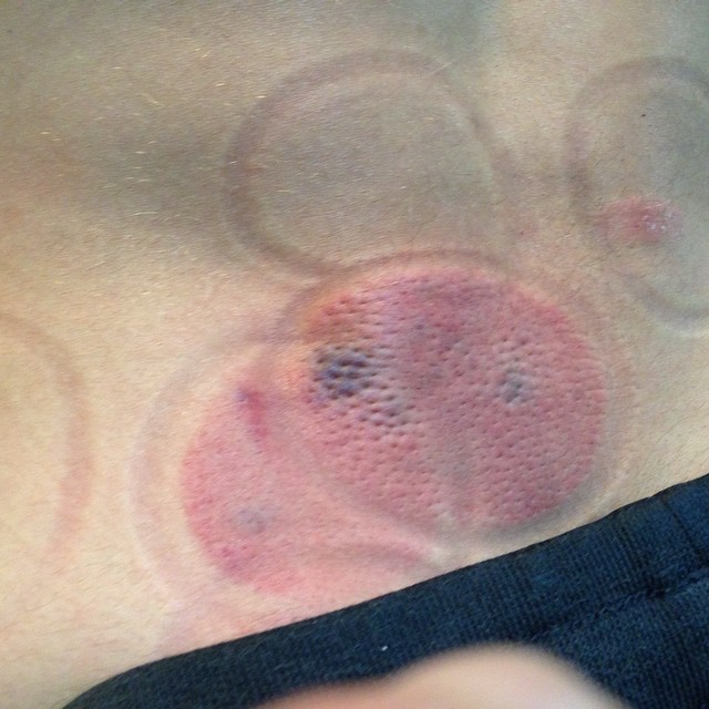 @chrisbashinelli cupping, old school healing #totalwellness #nomorepain