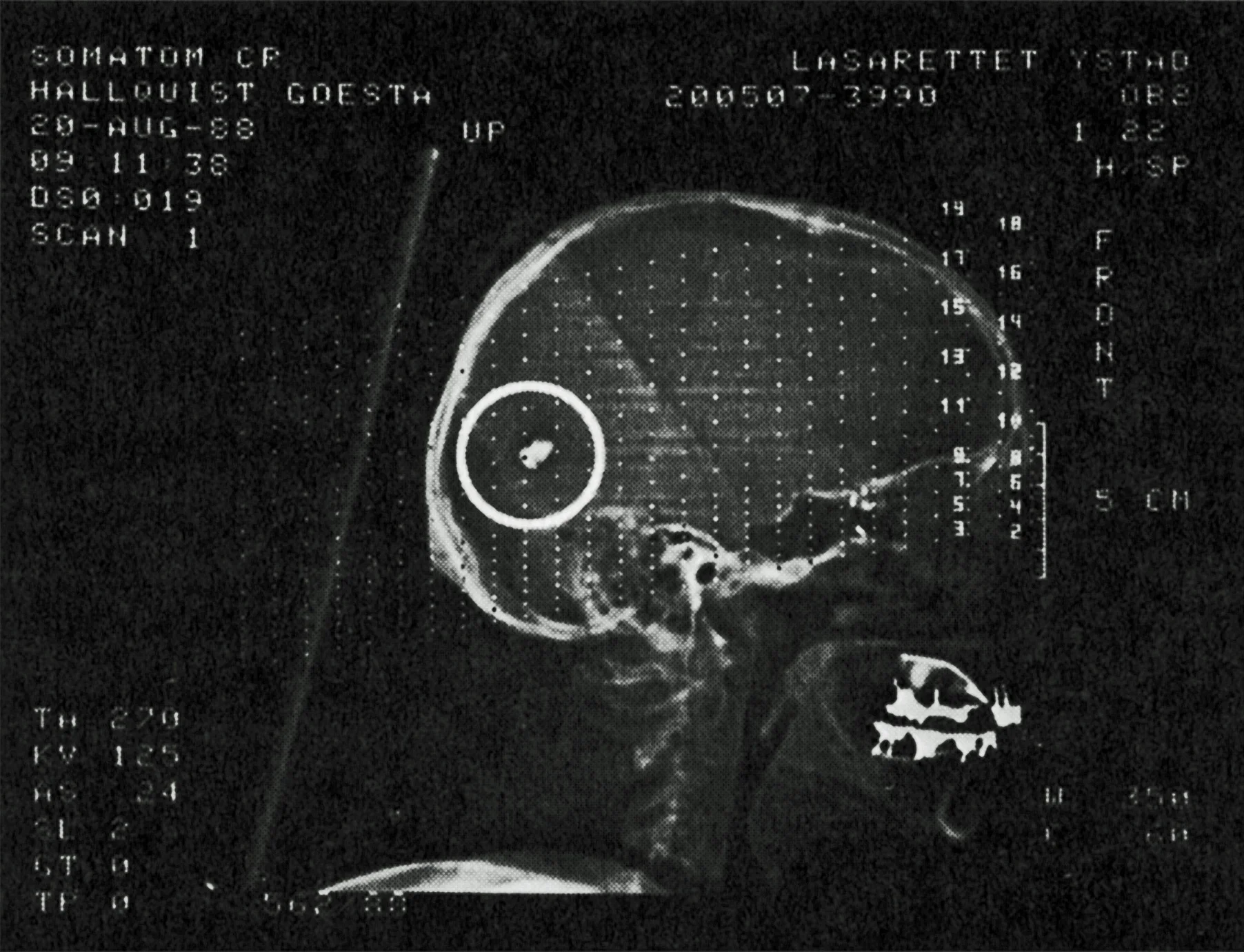 Bild från Löjtnant Hallquists dagbok. “På det här röntgenfotot från 1998 ser man tydligt kulan i bakre delen av huvudet. Dessutom sitter två splitter i vänstra tinningen.”