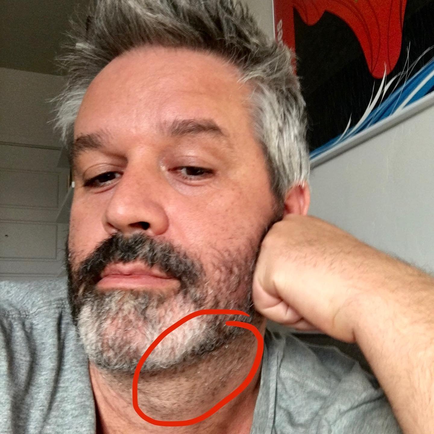 One of the more surprising discoveries I recently made was how vitamin C status affects hair growth rate and patterns. Because I had cystic fibrosis my entire life I never had adequate vitamin C status. All my adult life I had to shave my neck hair e