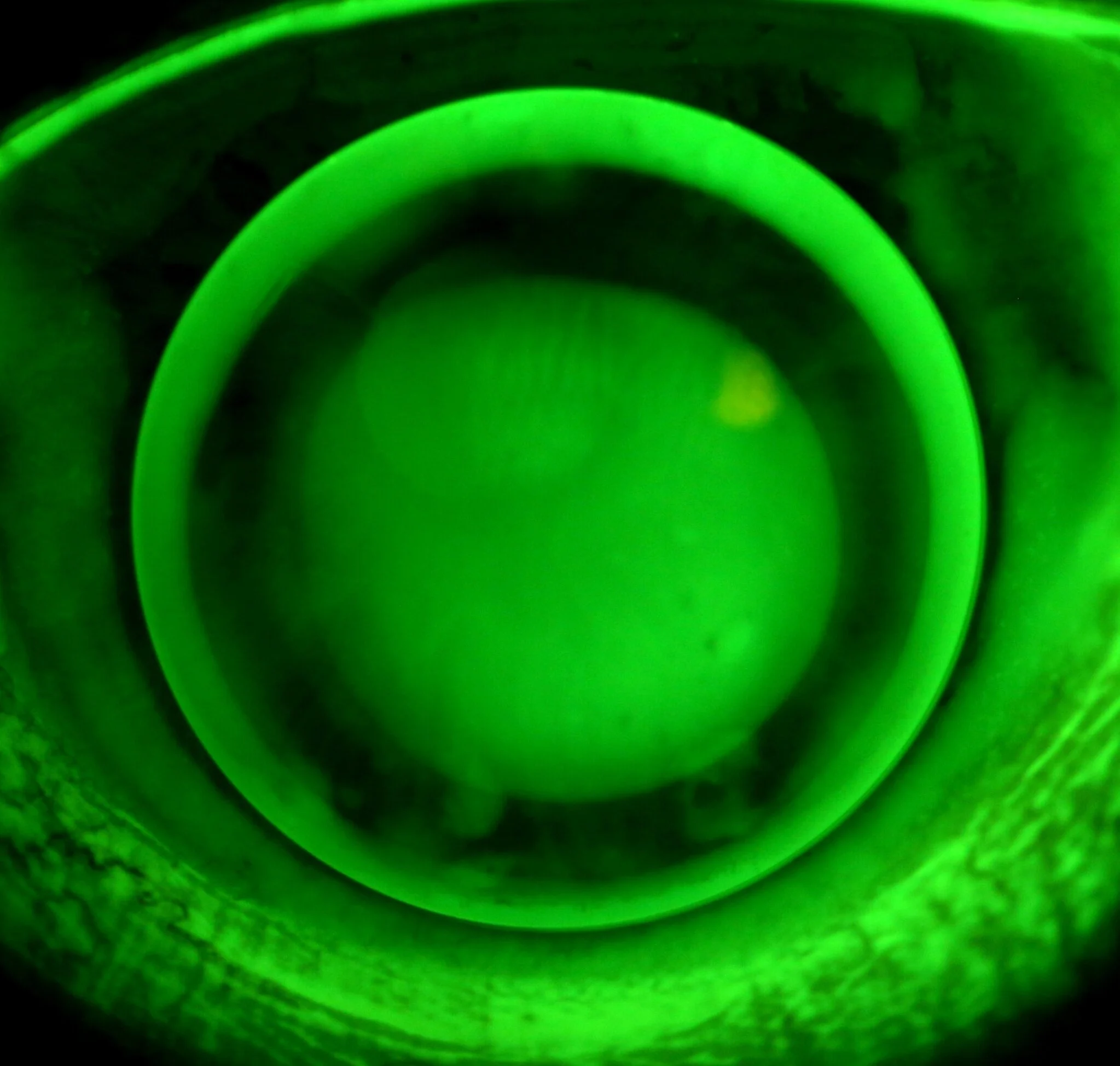Keratoconus Optometrist Melbourne - Information, Treatment and Support ...