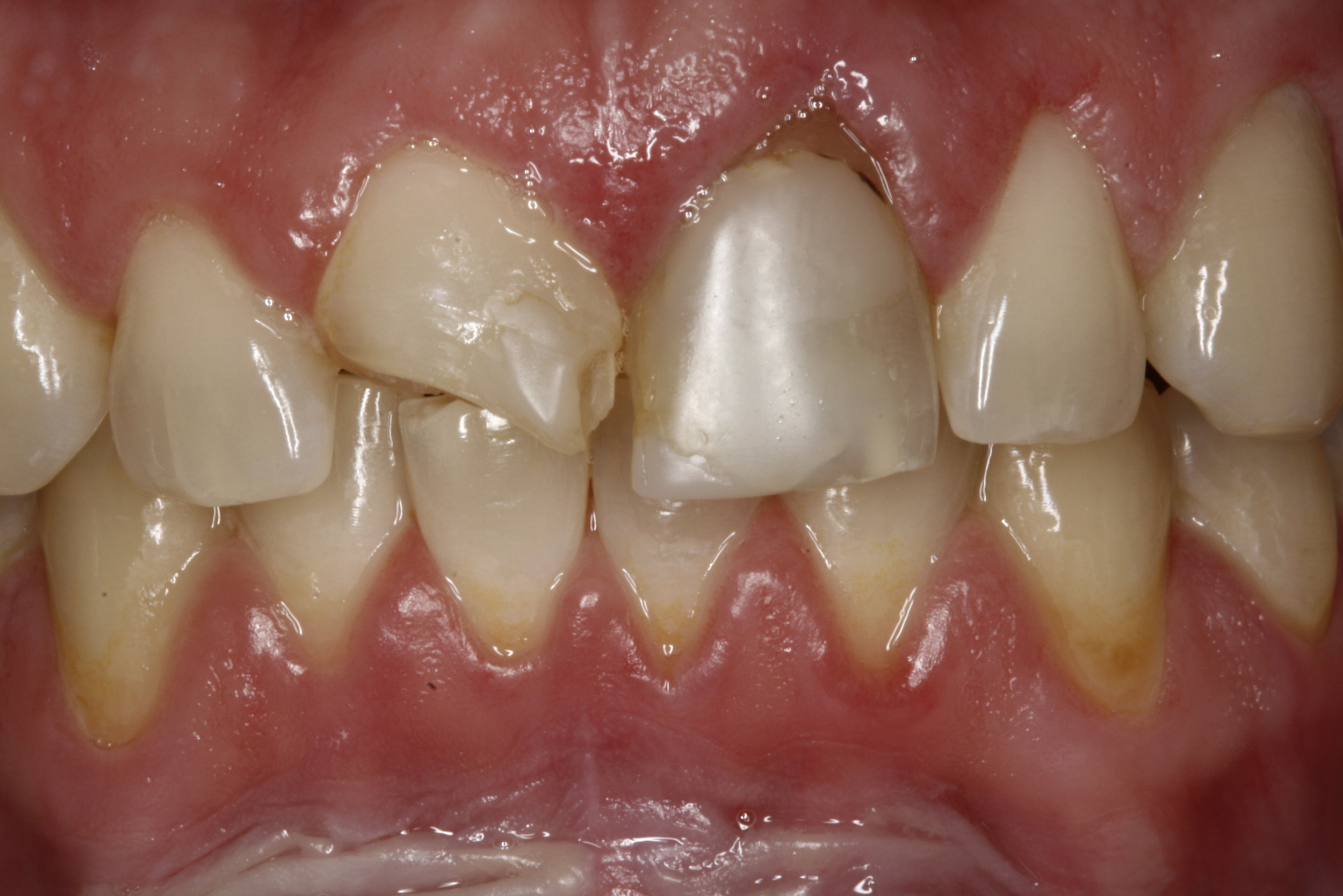 Crowns Case 1 — Lisa L. Buttaro DDS