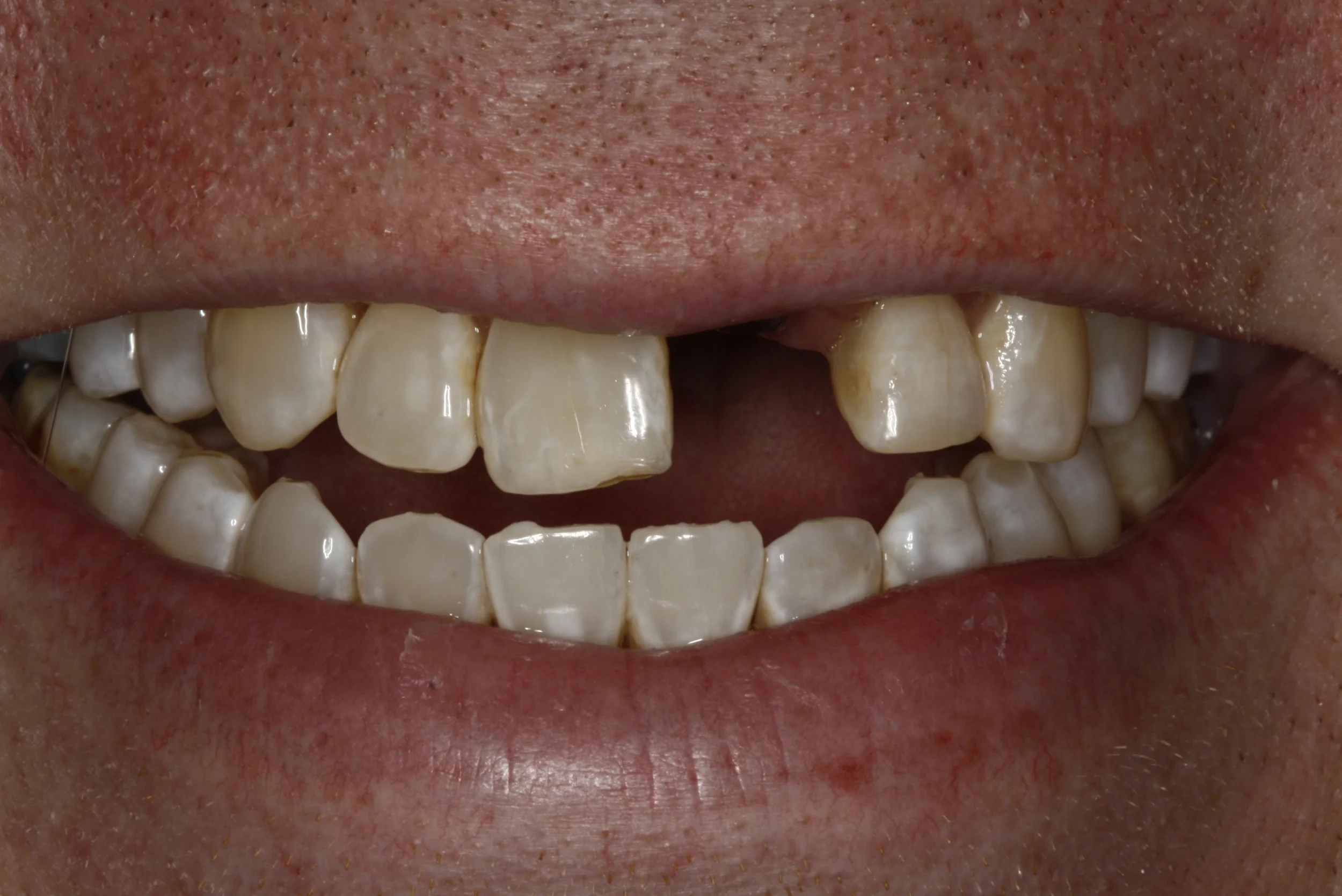 Implant Case 2 — Lisa L. Buttaro DDS