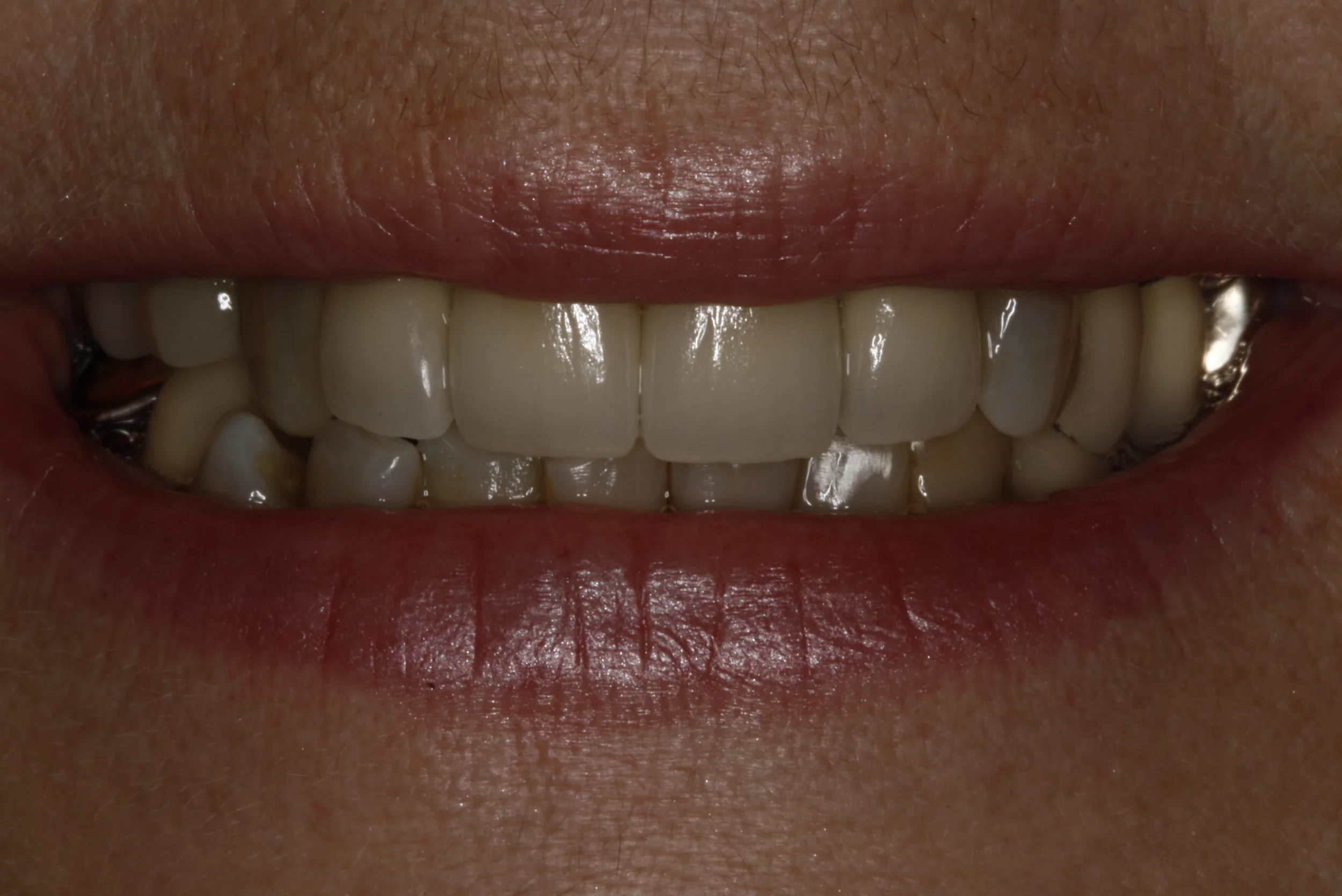 Crowns Case 3 — Lisa L. Buttaro DDS