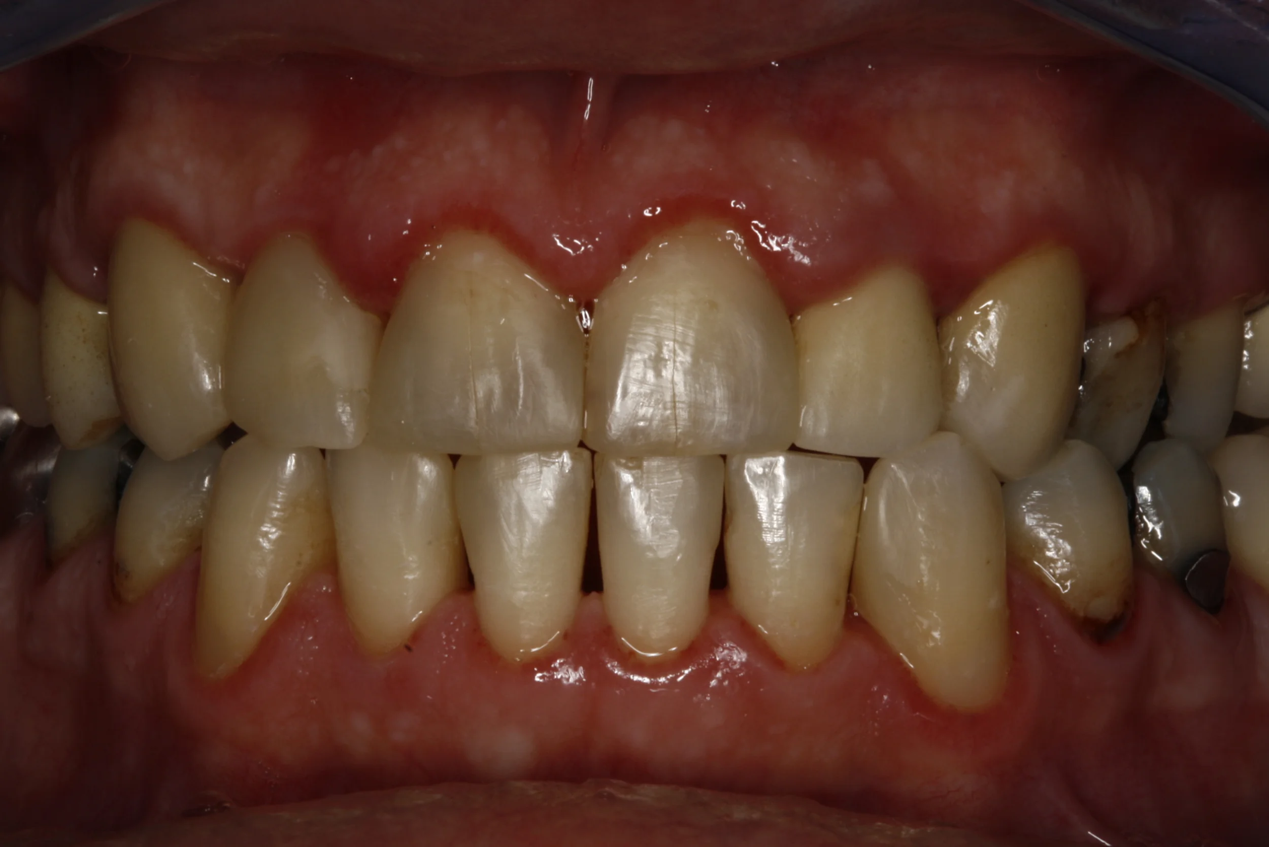 Composite Fillings Case — Lisa L. Buttaro DDS