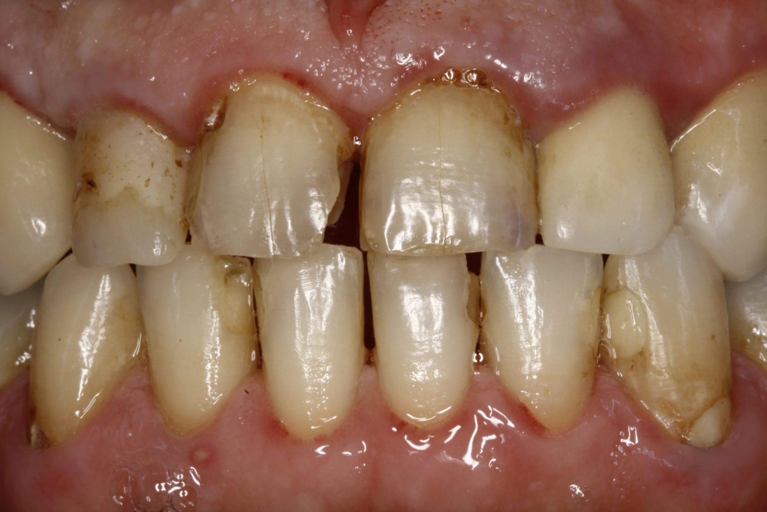 Composite Fillings Case — Lisa L. Buttaro DDS