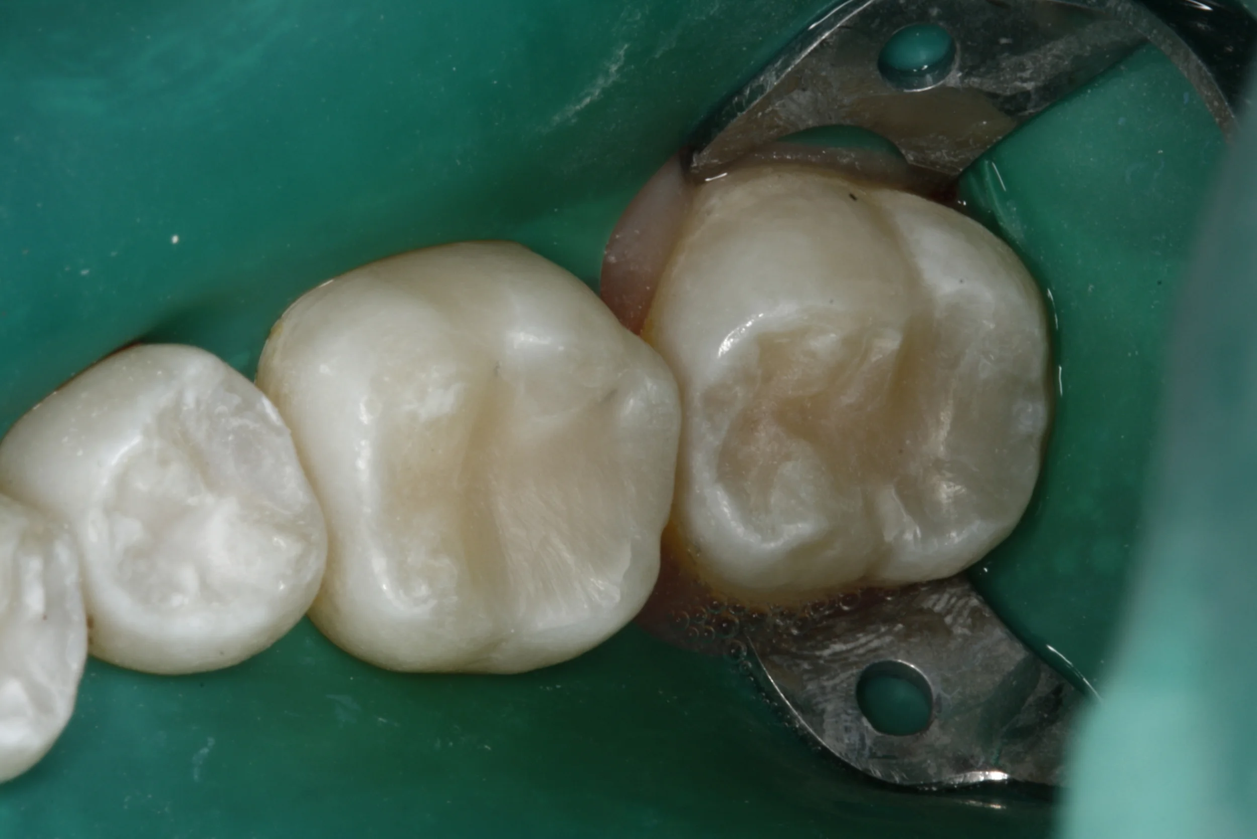Composite Fillings Case 5 — Lisa L. Buttaro DDS