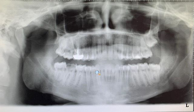 One of my first implant cases from 3 years ago on #31.  My patient was never able to bite on his right side due to his broken tooth.  Every time he comes in for his 6 month exam,  he thanks me for talking him into doing the implant!  But blames me fo