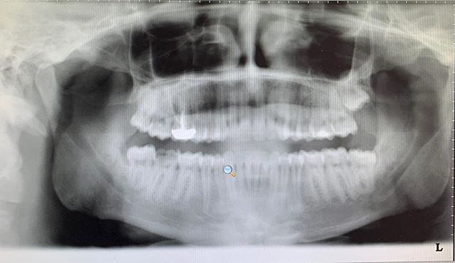 One of my first implant cases from 3 years ago on #31. My patient was never able to bite on his right side due to his broken tooth. Every time he comes in for his 6 month exam, he thanks me for talking him into doing the implant! But blames me for gaining 10 pounds 😂
