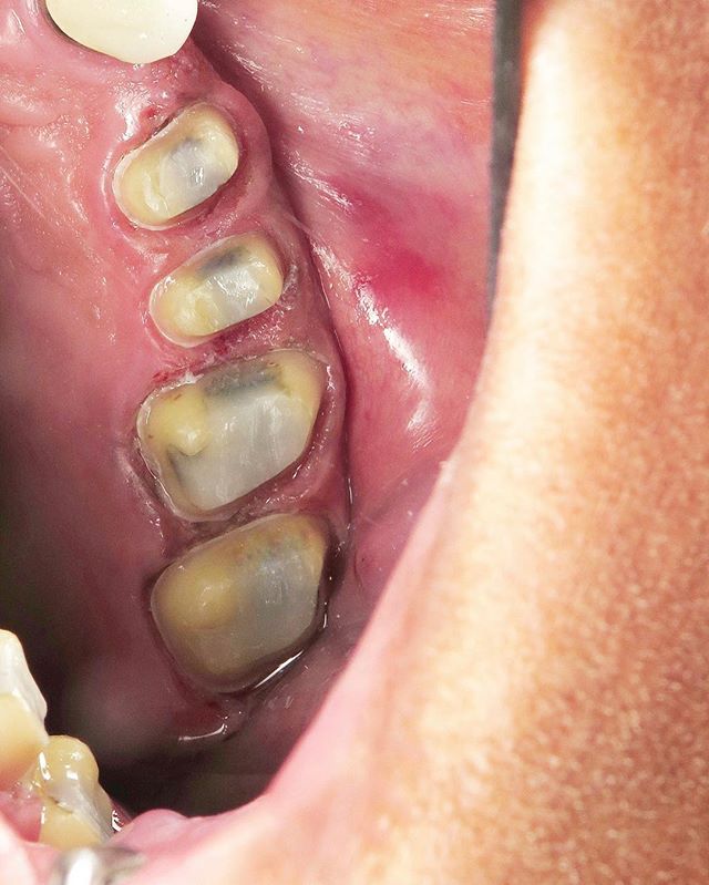 Happy Monday- these are how teeth look underneath crowns 👑