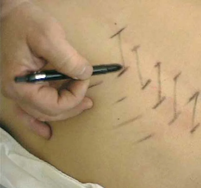 Pointing to T12 with a grease pen.JPG