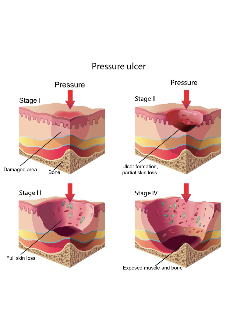 Pressure Ulcer Stage 2