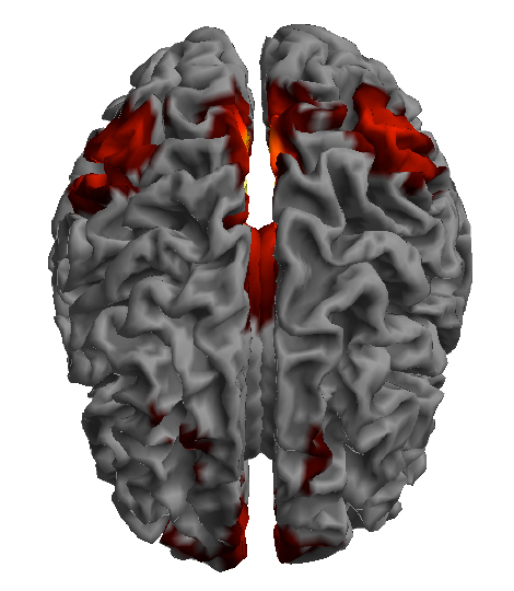 Resting-state functional MRI showing connectivity in the Default Mode Network - Image Credit: J. Posner
