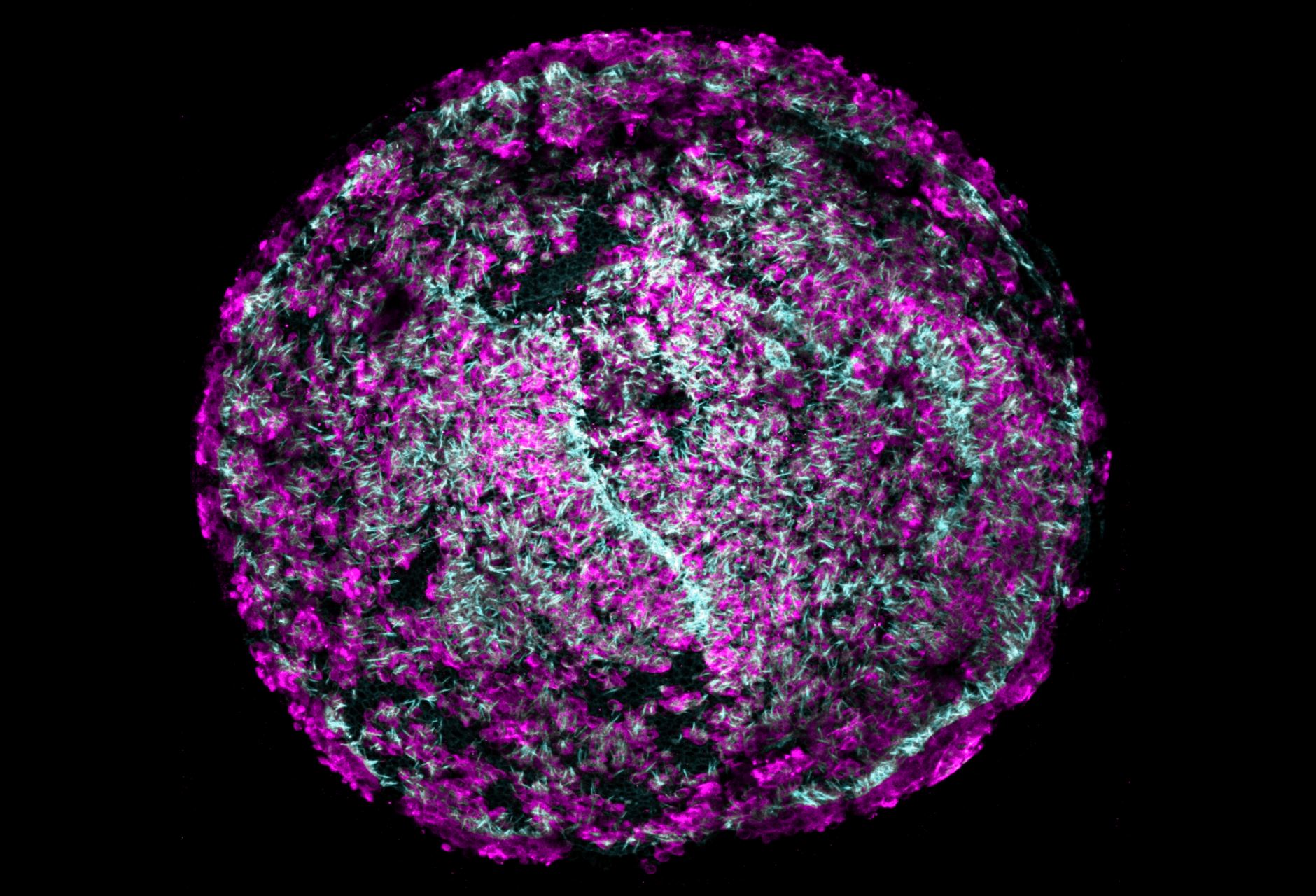 This image shows large clonal colonies of cochlear progenitor cells formed from single cells and converted into high-purity colonies of hair cells (magenta) with intricate hair bundles (cyan). - Image Credits: Will McLean